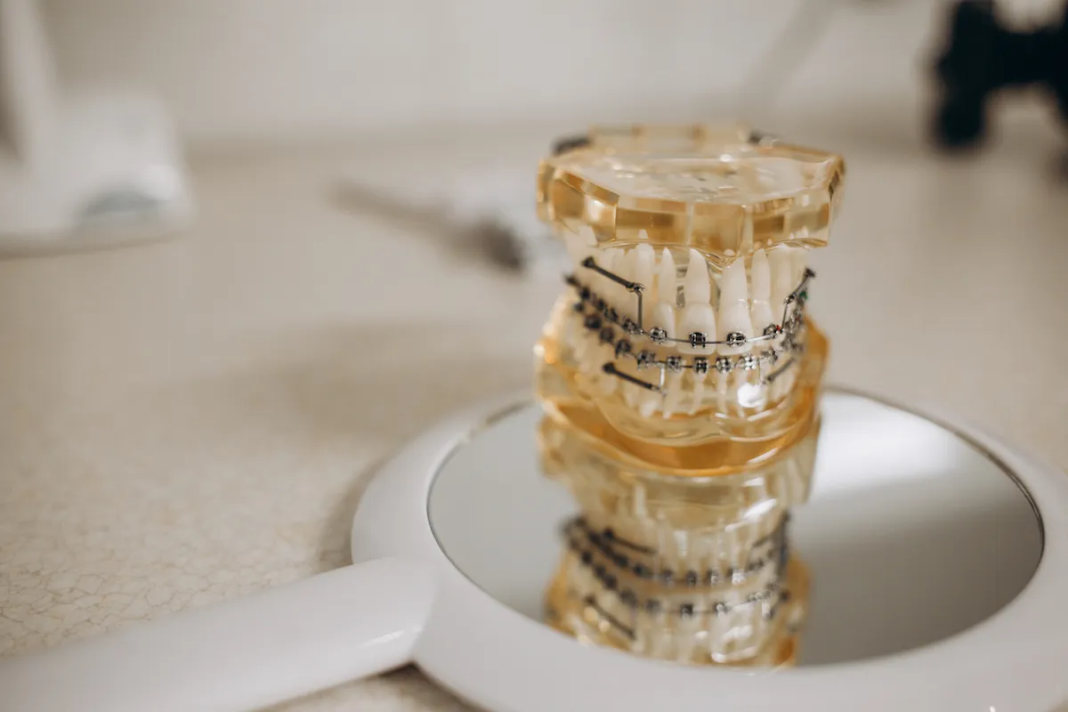 metal-and-ceramic-braces-on-teeth-on-an-artificial-2023-02-23-09-20-14-utc_11zon